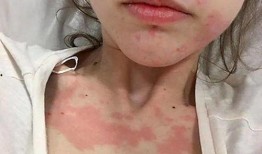 娱乐吃瓜酱过敏,吃瓜酱过敏背后的惊人真相